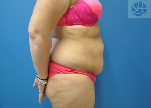 Tummy Tuck Before and After | Little Lipo