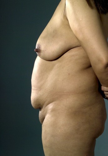 Tummy Tuck Before and After | Little Lipo