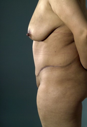 Tummy Tuck Before and After | Little Lipo