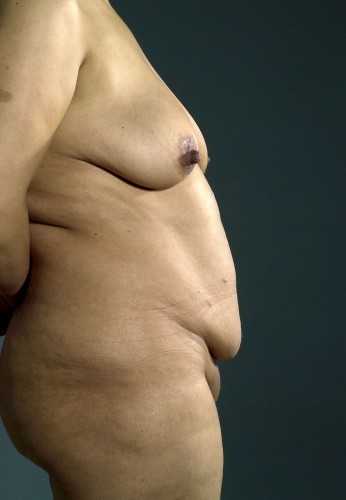 Tummy Tuck Before and After | Little Lipo