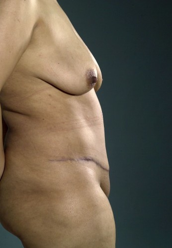 Tummy Tuck Before and After | Little Lipo