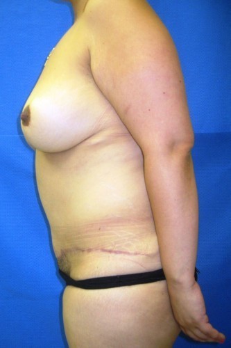Tummy Tuck Before and After | Little Lipo