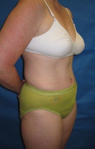 Tummy Tuck Before and After | Little Lipo