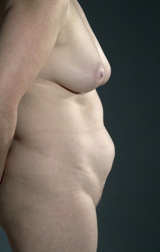 Tummy Tuck Before and After | Little Lipo