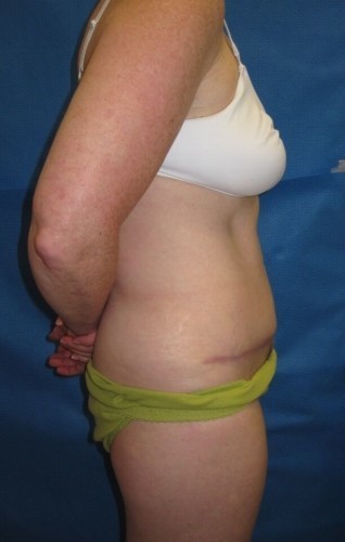 Tummy Tuck Before and After | Little Lipo