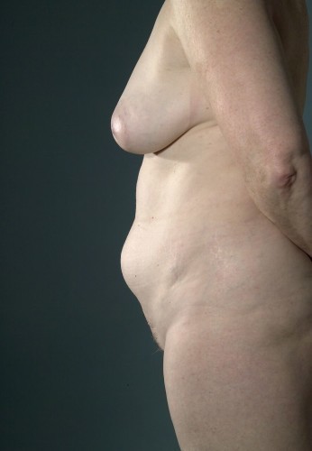 Tummy Tuck Before and After | Little Lipo
