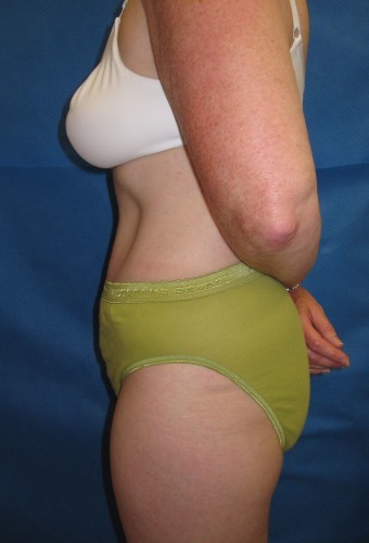 Tummy Tuck Before and After | Little Lipo