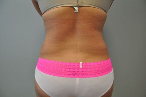 Tummy Tuck Before and After | Little Lipo
