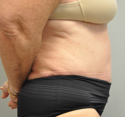 Tummy Tuck Before and After | Little Lipo