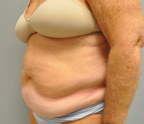 Tummy Tuck Before and After | Little Lipo