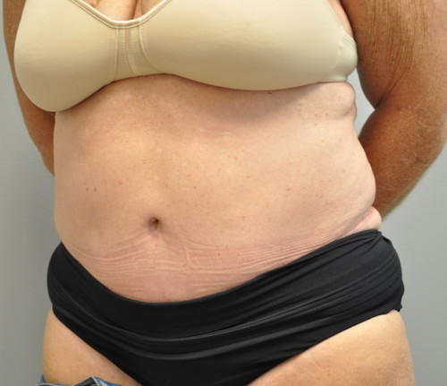 Tummy Tuck Before and After | Little Lipo