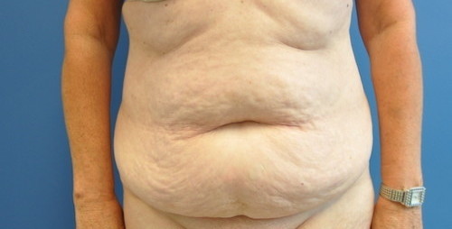 Tummy Tuck Before and After | Little Lipo