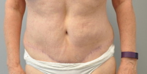 Tummy Tuck Before and After | Little Lipo