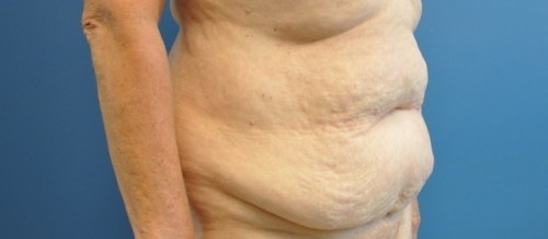 Tummy Tuck Before and After | Little Lipo
