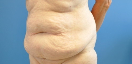 Tummy Tuck Before and After | Little Lipo