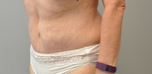Tummy Tuck Before and After | Little Lipo