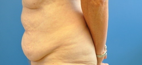Tummy Tuck Before and After | Little Lipo