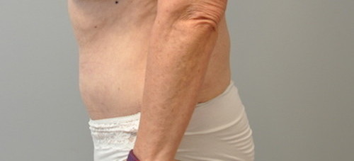 Tummy Tuck Before and After | Little Lipo