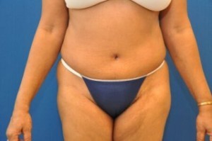 Tummy Tuck Before and After | Little Lipo