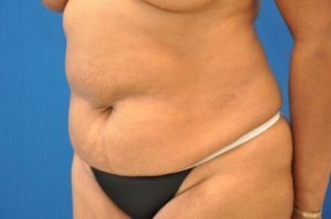 Tummy Tuck Before and After | Little Lipo