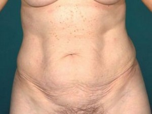 Tummy Tuck Before and After | Little Lipo
