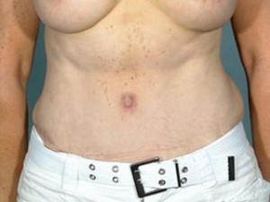 Tummy Tuck Before and After | Little Lipo