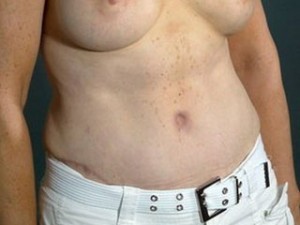 Tummy Tuck Before and After | Little Lipo