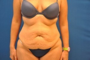 Tummy Tuck Before and After | Little Lipo