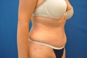 Tummy Tuck Before and After | Little Lipo