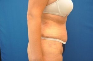 Tummy Tuck Before and After | Little Lipo