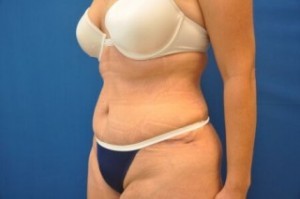 Tummy Tuck Before and After | Little Lipo