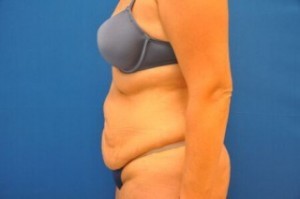 Tummy Tuck Before and After | Little Lipo