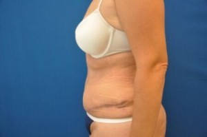 Tummy Tuck Before and After | Little Lipo