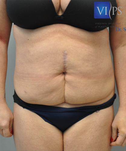 Tummy Tuck Before and After | Little Lipo