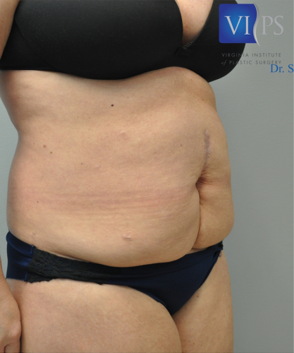 Tummy Tuck Before and After | Little Lipo