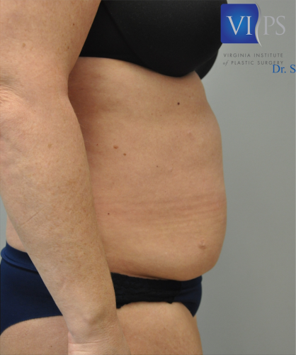 Tummy Tuck Before and After | Little Lipo