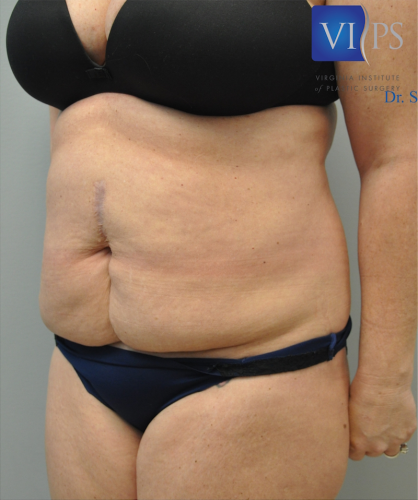 Tummy Tuck Before and After | Little Lipo