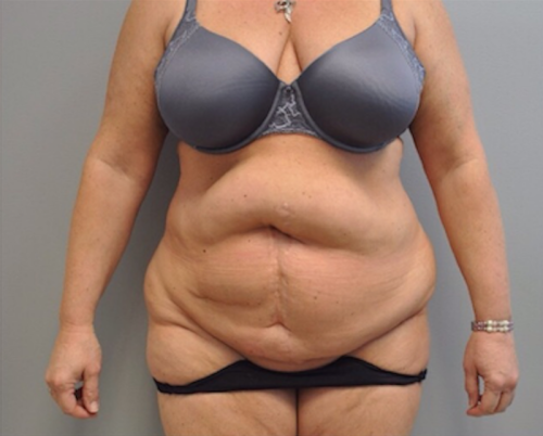 Tummy Tuck Before and After | Little Lipo