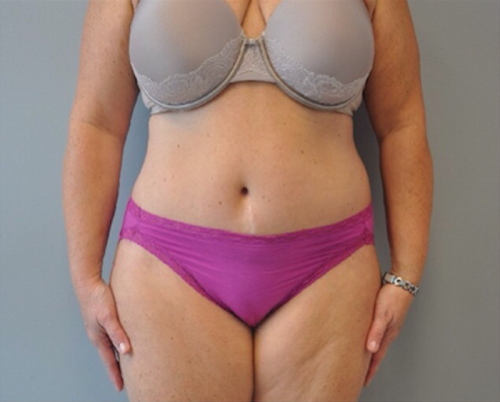 Tummy Tuck Before and After | Little Lipo