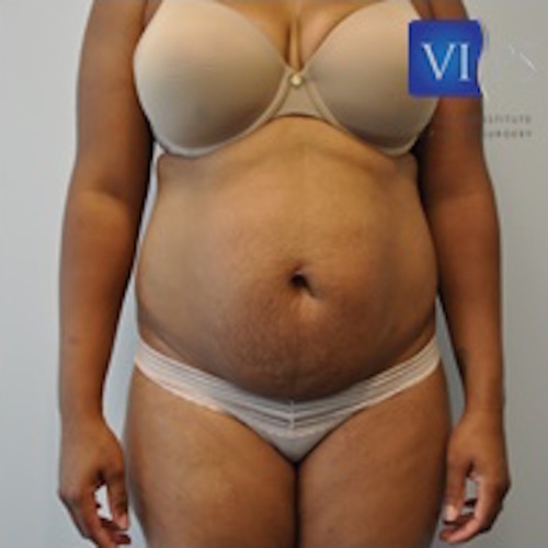 Tummy Tuck Before and After | Little Lipo