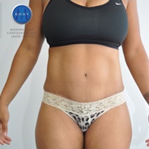 Tummy Tuck Before and After | Little Lipo