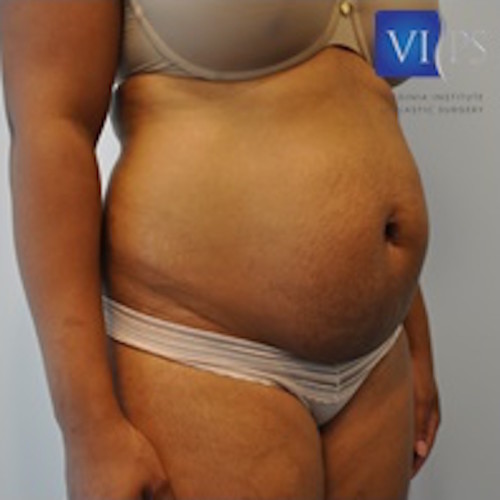 Tummy Tuck Before and After | Little Lipo