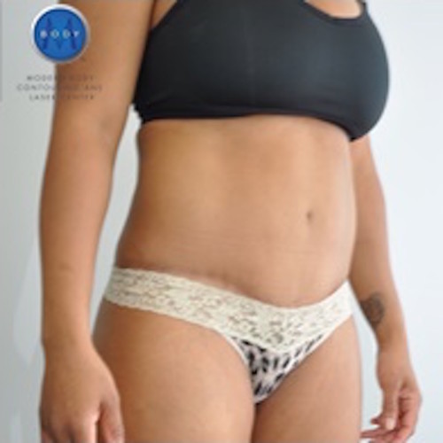 Tummy Tuck Before and After | Little Lipo