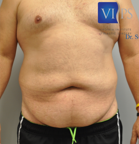 Tummy Tuck Before and After | Little Lipo