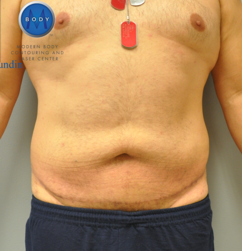 Tummy Tuck Before and After | Little Lipo
