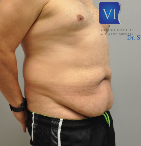 Tummy Tuck Before and After | Little Lipo