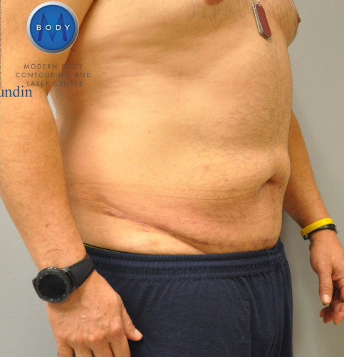 Tummy Tuck Before and After | Little Lipo