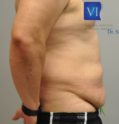 Tummy Tuck Before and After | Little Lipo