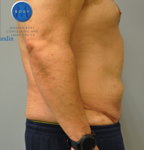 Tummy Tuck Before and After | Little Lipo