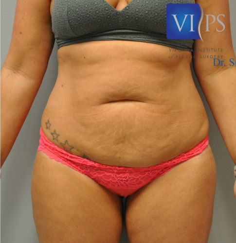 Tummy Tuck Before and After | Little Lipo